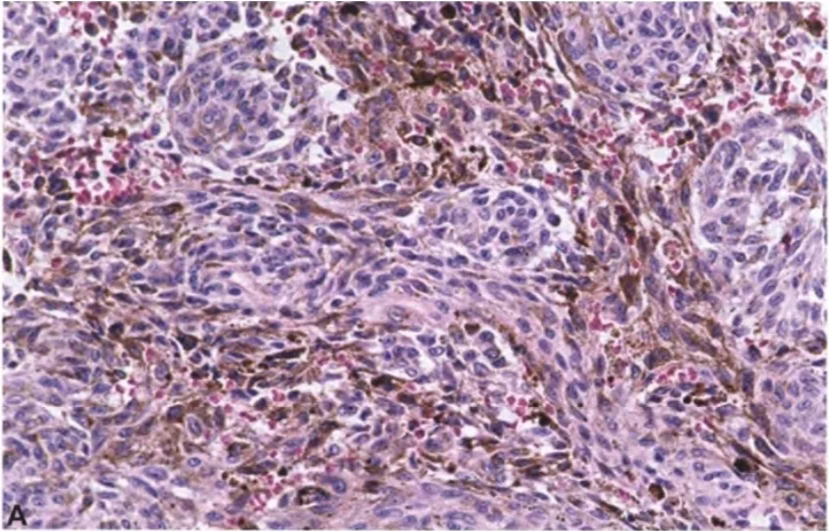 Fig. 12.04 Meningeal melanocytoma. A Loose or tight nests Of low-grade, pigmented spindle cells with intervening stroma containing higher levels Of melanin pigment. Note the vague, loosely formed whorls and fascicles. B Accumulation Of large, melanin-containing macrophages (melanophages) seen between turnour cells with a more spindled phenotype. The nuclei of tumour cells are bean-shaped and have micronucleoli. Melanin within the cytoplasm Of melanophages is typical in larger aggregates. C Melanin-containing macrophages (melanophages). 