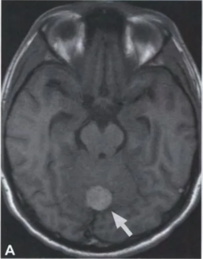 ig. 12.03 MRI features Of meningeal melanocytoma. A Tl-weighted axial images (pre-contrast) reveal a hyperintense, well-circumscribed mass in the midline Of the cerebellum rising from the dura. B On T2-weighted images, the mass is hypointense. C Following the administration Of contrast agent, the melanocytoma shows homogeneous enhancement. 