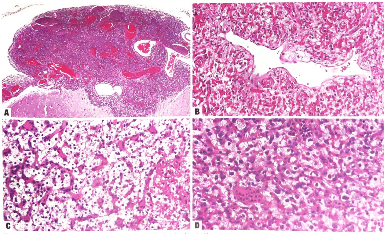 Haemangioblastoma. 
A) Intradural, extramedullary localization is typical for spinal haemangioblastomas. Most tumours are well circumscribed, but they may also encroach on the spinal cord parenchyma. 
B) Abundant vascularity of haemangioblastoma is often in the form of thin-walled vessels.Some vessels appear as highly branching staghorn vessels.
C) Neoplastic stromal cells have clear to vacuolated cytoplasm admixed with abundant capillary vessels. 
D) The stromal cells show mild nuclear pleomorphism. There is a rich capillary network.