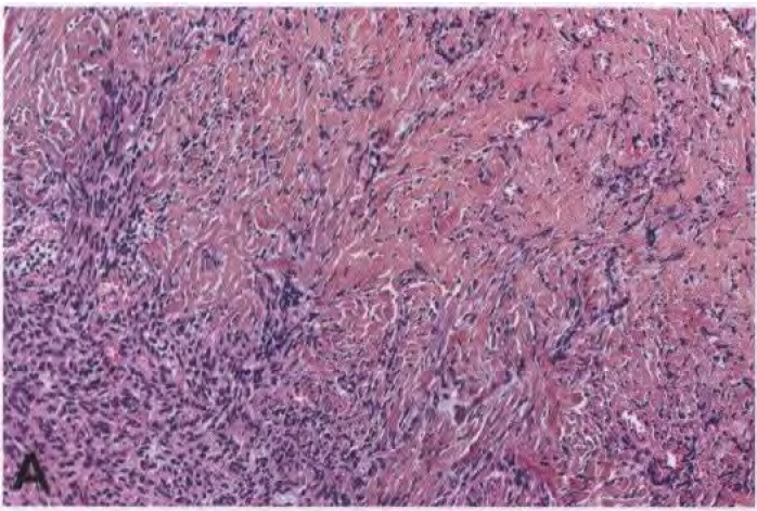 Pattern-less architecture with alternating hypocellular and hypercellular areas