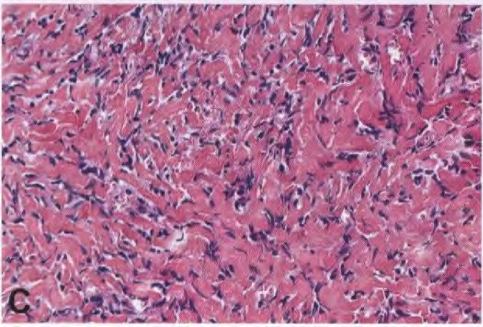 Hypocellular areas with thick bands of collagen