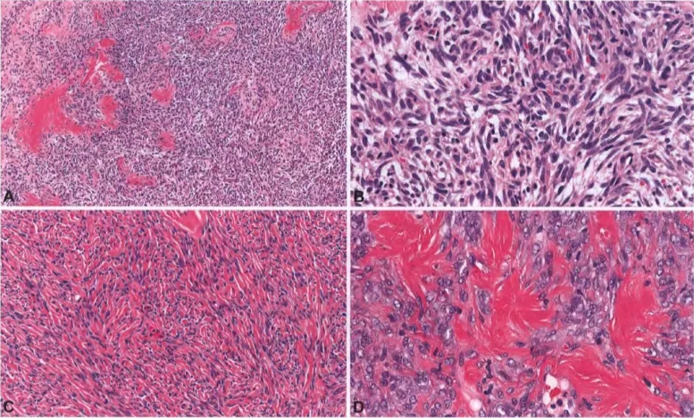 Fig. 11.03 Solitary fibrous tumour phenotype. A Patternless architecture characteristic of this phenotype. B The tumour is composed of cells with bland ovoid to spindle-shaped nuclei and scant eosinophilic cytoplasm. C Stromal and perivascular hyaline collagen deposition and (D) keloidal or amianthoid-like collagen are common. 
