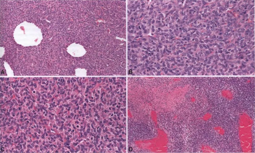 Fig. 11.05 The haemangiopericytoma phenotype. A Diffuse high cellularity, with thin-walled, branching vessels. B Closely apposed cells with round to ovoid nuclei arranged in a haphazard pattern, with limited intervening stroma. C Numerous mitoses. D Focal necrosis is typically present. 