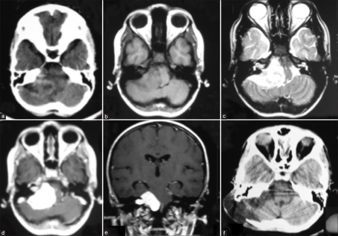 (a) CECT showing a heterogeneously enhancing extra-axial tumor in the right CPA cistern; (b) MRI T1W shows an isointense lesion in the right CPA, note the gross distortion of the pons. The tumor measured 4×4.5×5.5 cm; (c) On T2W, the lesion is hyperintense, with clefts of CSF seen adjacent to the cerebellum and the brainstem; (d) T1W post-gadolinium contrast shows bright contrast enhancement with an intrametal extension; (e) Coronal T1W post-gadolinium contrast shows the tumor causing gross brainstem distortion, with the rostral extent reaching the tentorium with no hydrocephalus; (f) postoperative CECT, 3 weeks after surgery shows no residual tumor. Postoperative craniectomy defect and a pseudomeningocoele is seen