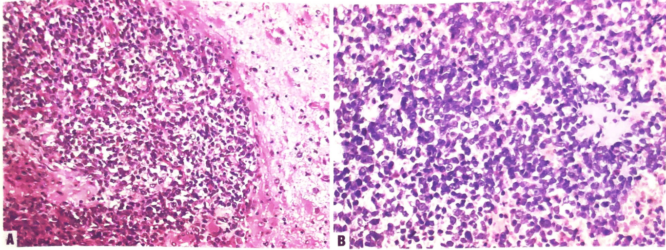 A: A primary tumour in the cerebrum showing a well-circumscribed nodule in the brain parenchyma. 
B: There is a diffuse proliferation of small round cells with minimally pleomorphic nuclei and variably prominent nucleoli.