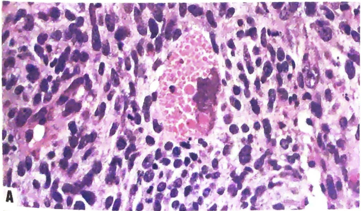 These tumours frequently contain cells with prominent eosinophilic cytoplasmic globules. 