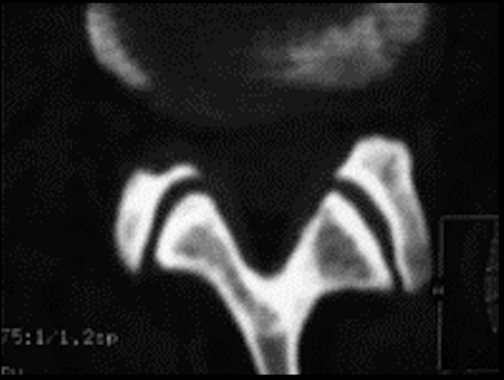 Fluid in the facet joint