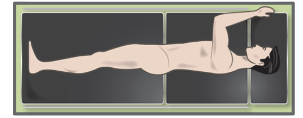 Patient place so that GT is at the breakage point and a bit of the iliac crest is above the break