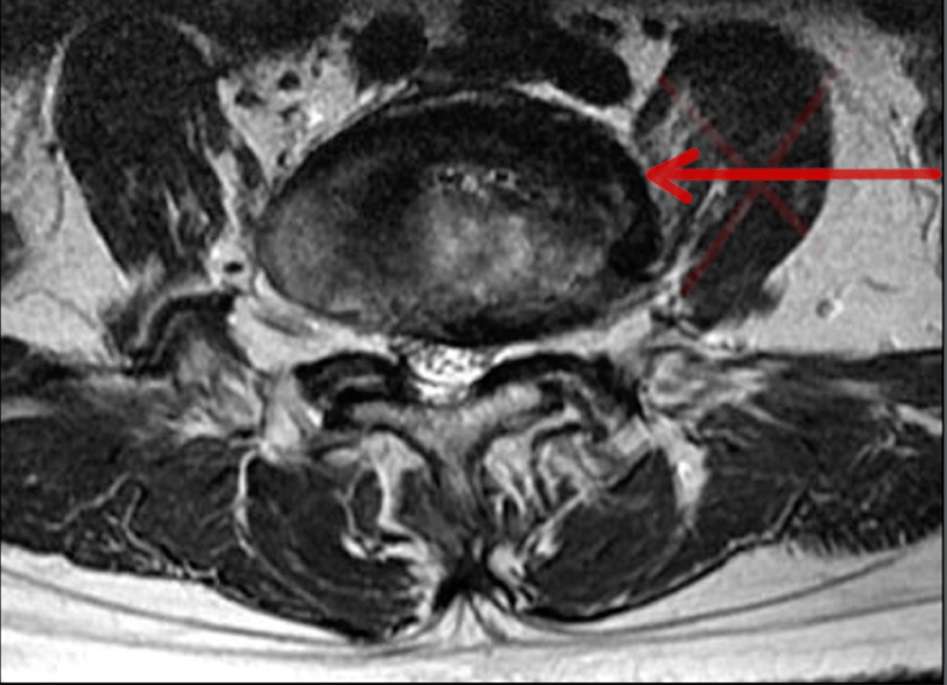 The L4/5 is transitional and the psoas is larger and therefore the lumbar plexus is more anterior. Best to use a different interbody technique