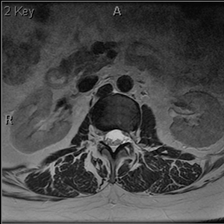 Retroperitoneal fat around the kidneys