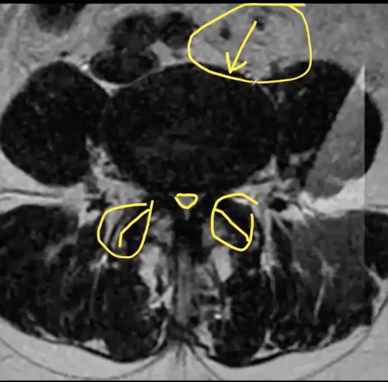 L4/5 level where the psoas is the same size as the vertebral body 