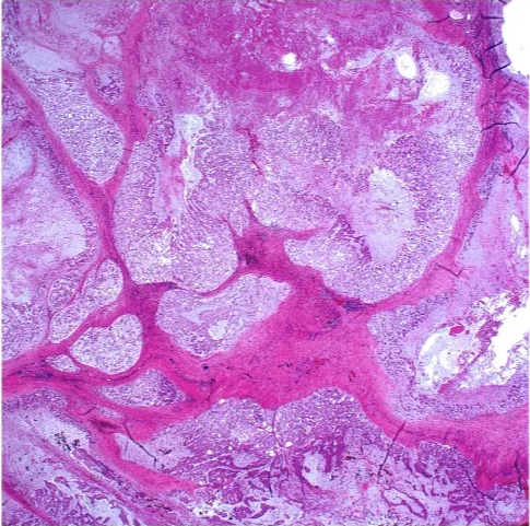 Low power view of chordoma shows a lobular architecture, in which lobules are separated by fibrous bands. 