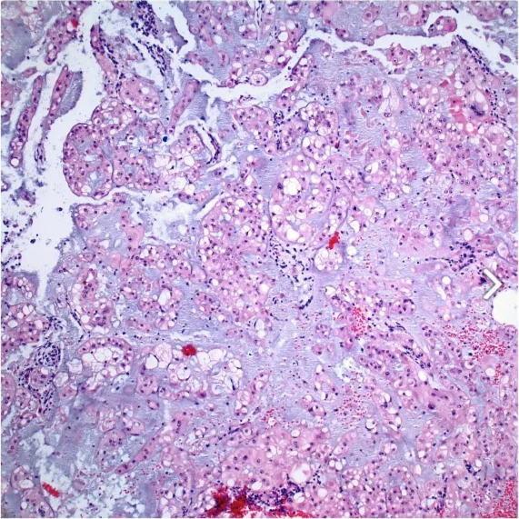Chordoma, NOS composed of epithelioid cells with eosinophilic to clear, bubbly cytoplasm arranged in nests, chords and individual cells in a myxoid stroma. 