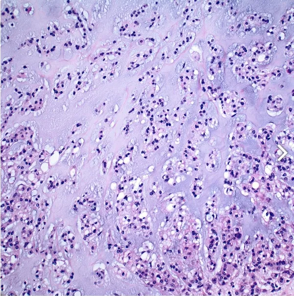 Cells reside in abundant myxoid stroma. 