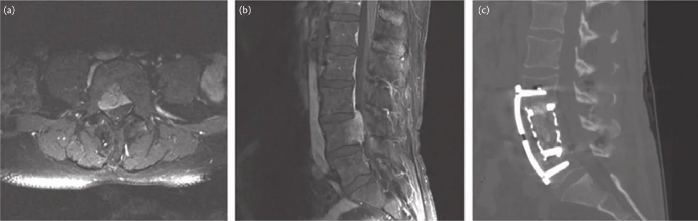 (a) (b) (c) Fig. 63.9 CT and magnetic resonance images of lumbar chordoma preoperative axial magnetic resonance images of lumbar chordoma (left); preoperative sagittal magnetic resonance images of lumbar chordoma (middle); and postoperative lateral radiographs (right) (see Ozaki et al., 2002). 