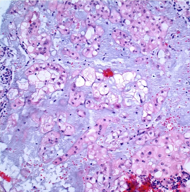 High power view of chordoma demonstrates cells with vesicular chromatin and bubbly to vacuolated cytoplasm called physaliphorous cells. 