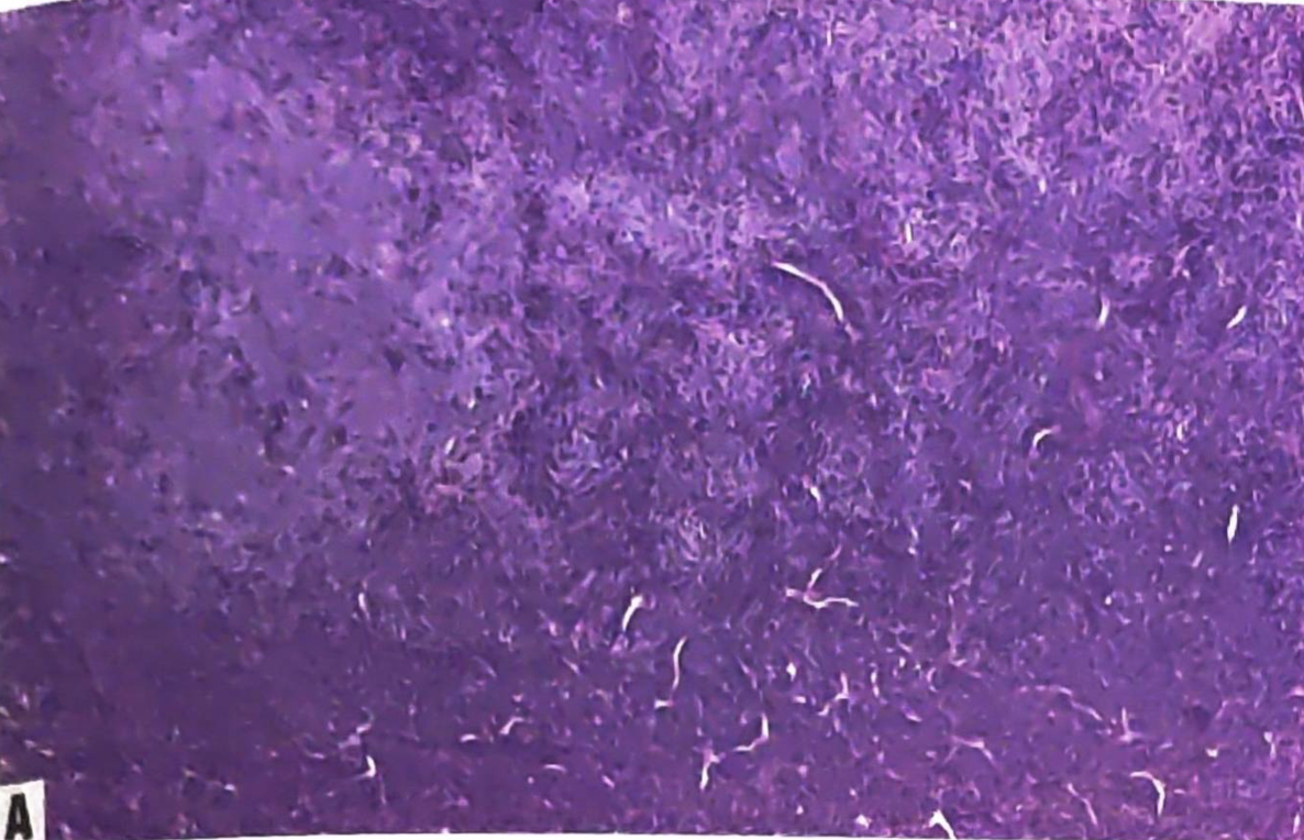 Mesenchymal chondrosarcoma is a highly cellular biphasic tumour composed of areas of undifferentiated round cells with high N:C ratios, as well as numerous staghorn vessels, and islands of hyaline cartilage