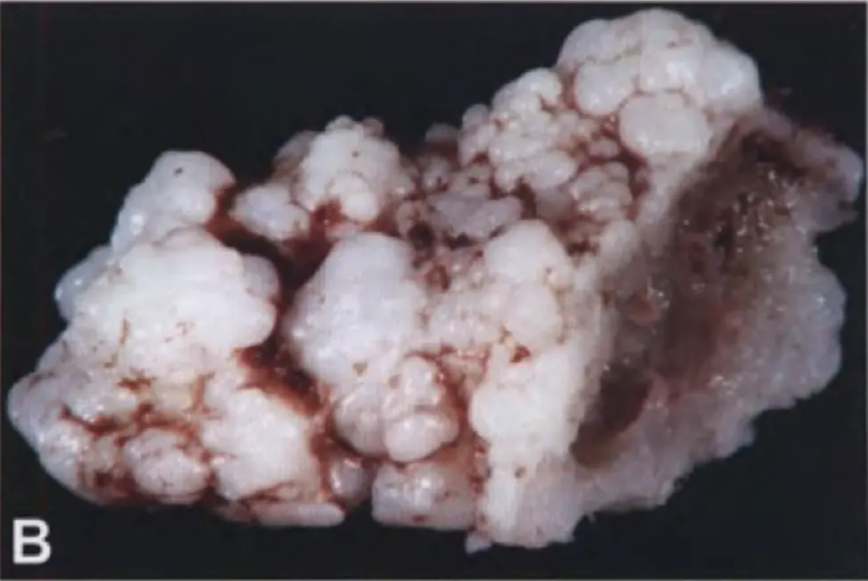 Chondrosarcoma: Meningeal low-grade chondrosarcoma showing glistening nodules of hyaline cartilage with focal softening and liquefaction.