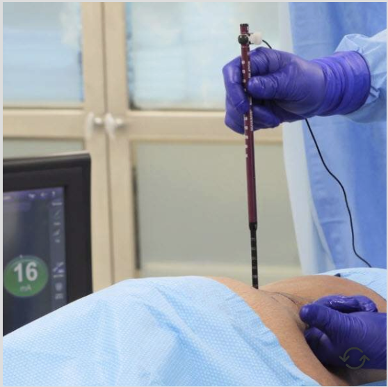 Sequential dilation of the psoas