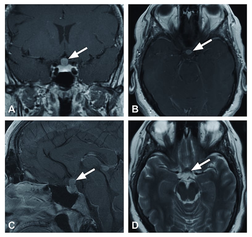 A hypoenhancing T1 and T2 intermediate lesion arising from the postero-superior aspect of the pituitary gland. The sellar-suprasellar lesion approximately 10 mm x 6 mm x 7 mm enhances with gadolinium administration. A) Coronal T1 post-gadolinium, B) axial T1 post-gadolinium, C) sagittal T1 post-gadolinium, D) axial T2.