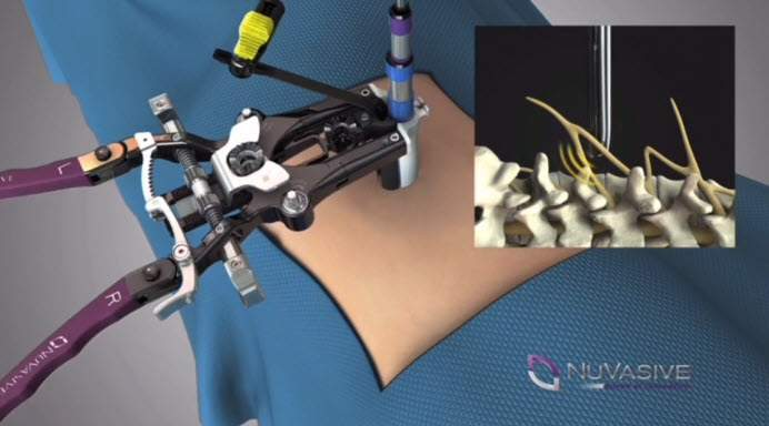 With the closed distal end of the retractor over the dilators, lower into the patient (once at the psoas, use neuromonitoring).