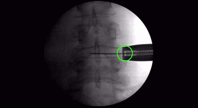 Take a fluoro image to confirm position (look for the "snake eyes" at the end of the retractor).