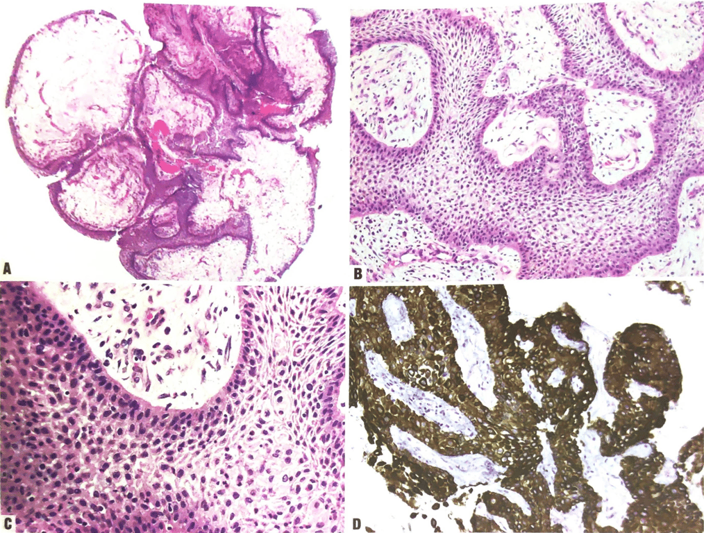 A) Papillary architecture
B) Well-differentiated non-keratinizing squamous epi thelium covering fibrovascular cores that contain a low density of fibroblasts and immune cells Including lymphocytes, macrophages, and neutrophils
C) Well-differentiated non-keratinizing squamous epithelium with intercellular bridges and abundant tumour-infiltrating neutrophils, which are common in these tumours
D) Immunohistochemistry tor CK5/6 (an antibody against the intermediate-weight keratins CK5 [58 kDa] and CK6 [56 kDa]) is positive throughout all layers. Staining for CK19 is also positive. Another marker commonly used to assess squamous cell carcinomas of all types, p63, is also immunoreactive in almost all papillary and adamantmomatous craniopharyngiomas