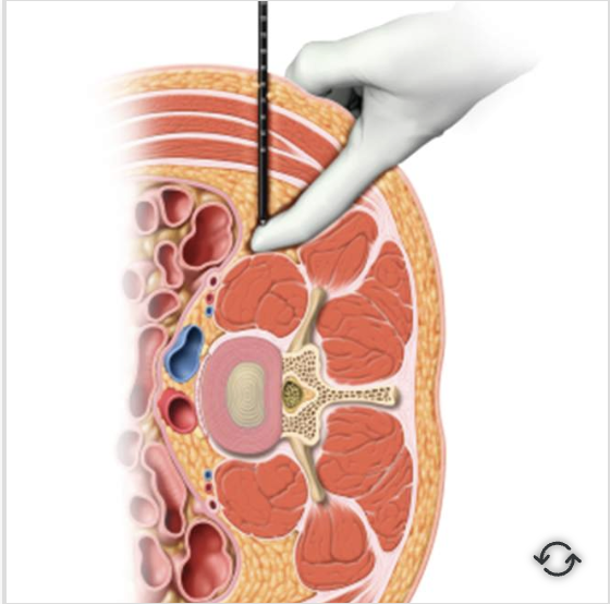 Place the initial dilator is in the psoas muscle 