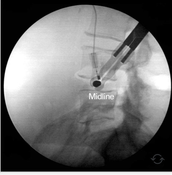 The tip is now more anterior 