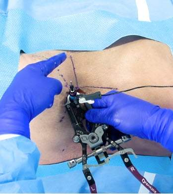 Reference line drawn (angle of disc space) and rotate the retractor so the line bisects the MaXcess retractor handles. 