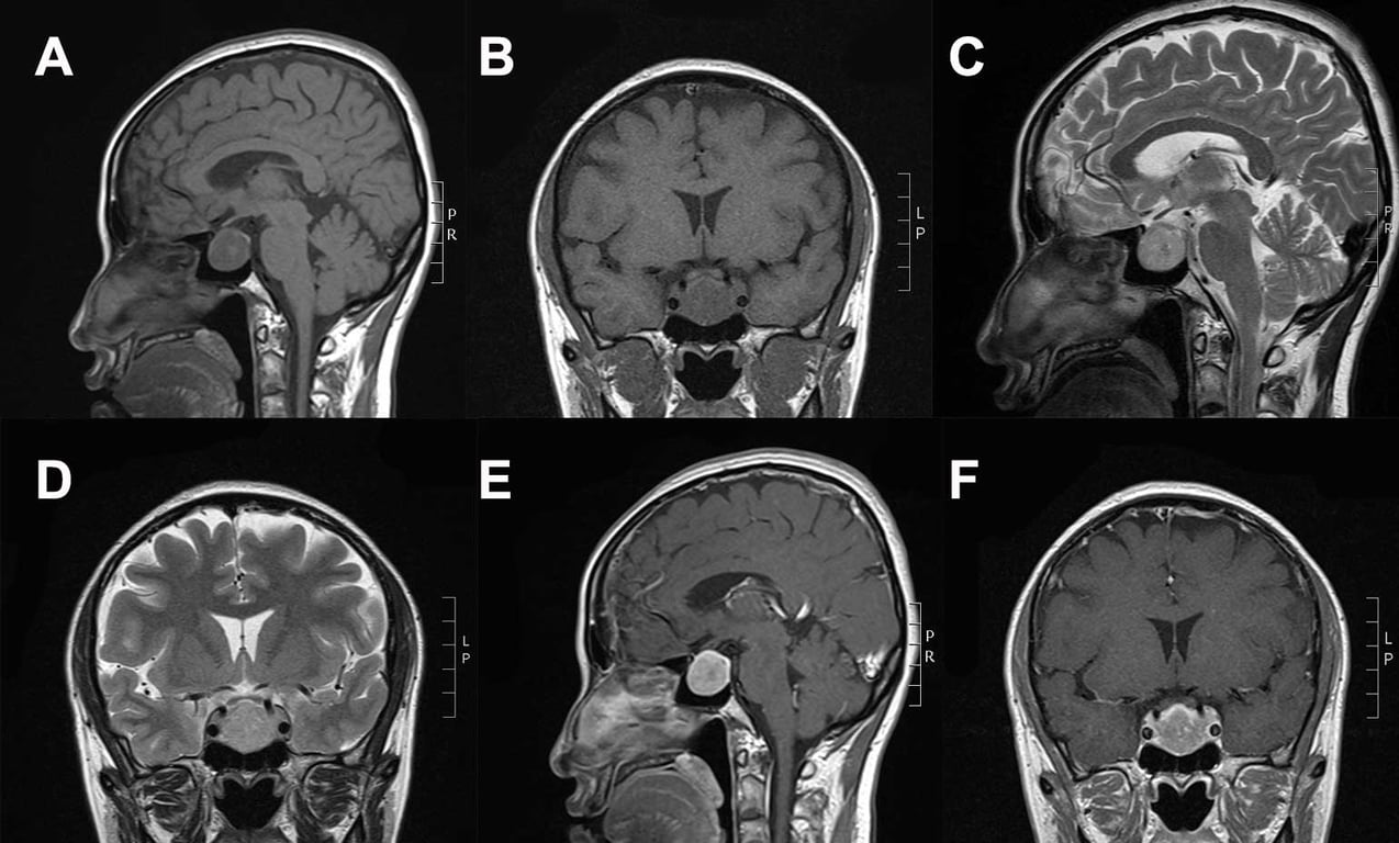 Contrast enhanced mass in the sellar and suprasellar regions. (A and B) The mass demonstrated hypointensity on T1WI and (C and D) heterogeneous hyper intensity on T2WI; (E and F) the tumor demonstrated clear homogeneous enhancement following Gd-DTPA administration.