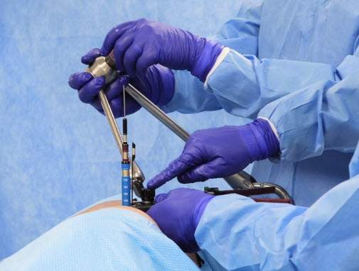 With the retractor oriented to the operative segment, connect the rigid arm to the MaXcess retractor.