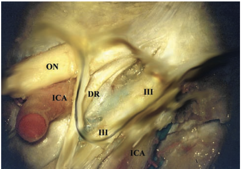 Anatomical dissection of the anterior clinoid process and the different neurovascular entities within the wall of the anterior clinoid process. ON, optic nerve; DR, dural ring; ICA, internal carotid artery; III, oculomotor nerve.