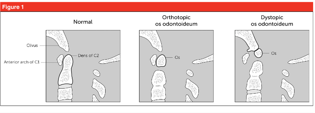 Figure 1 from Os Odontoideum in Children | Semantic Scholar