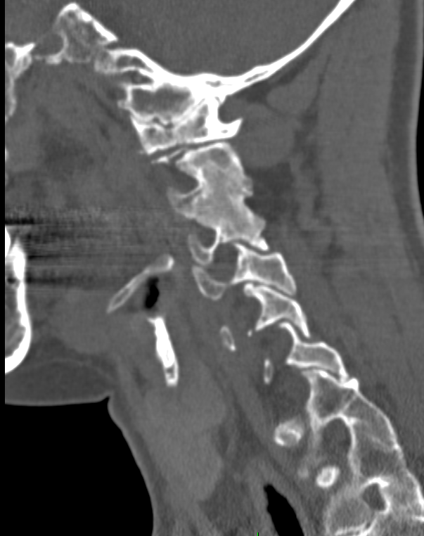 A close-up of a spine x-ray AI-generated content may be incorrect.