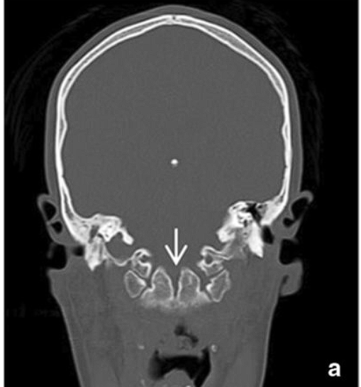 An x-ray of a skull AI-generated content may be incorrect.