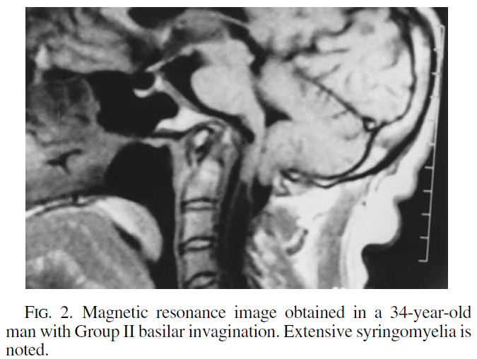 Close-up of an x-ray of a brain AI-generated content may be incorrect.