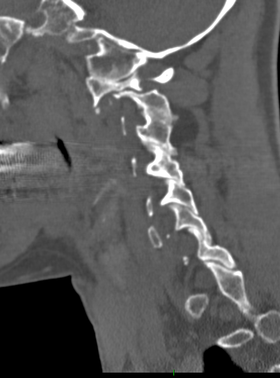 A close-up of a spine x-ray AI-generated content may be incorrect.