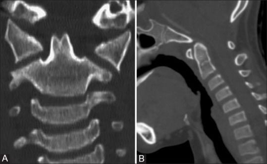 A close-up of an x-ray of a human spine AI-generated content may be incorrect.
