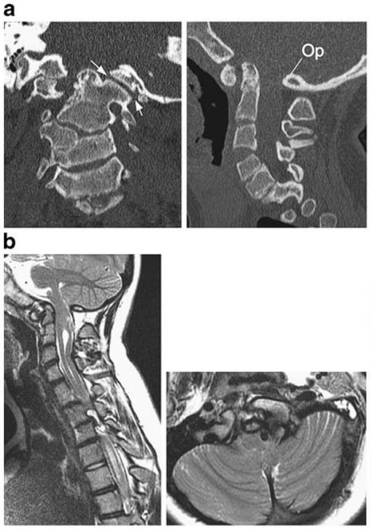 A close-up of several images of a spine AI-generated content may be incorrect.