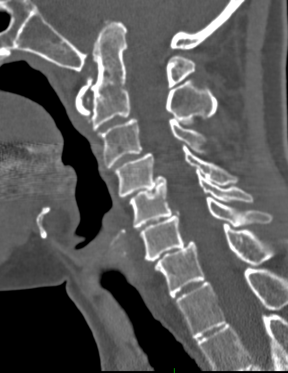 A close-up of an x-ray of a spine AI-generated content may be incorrect.