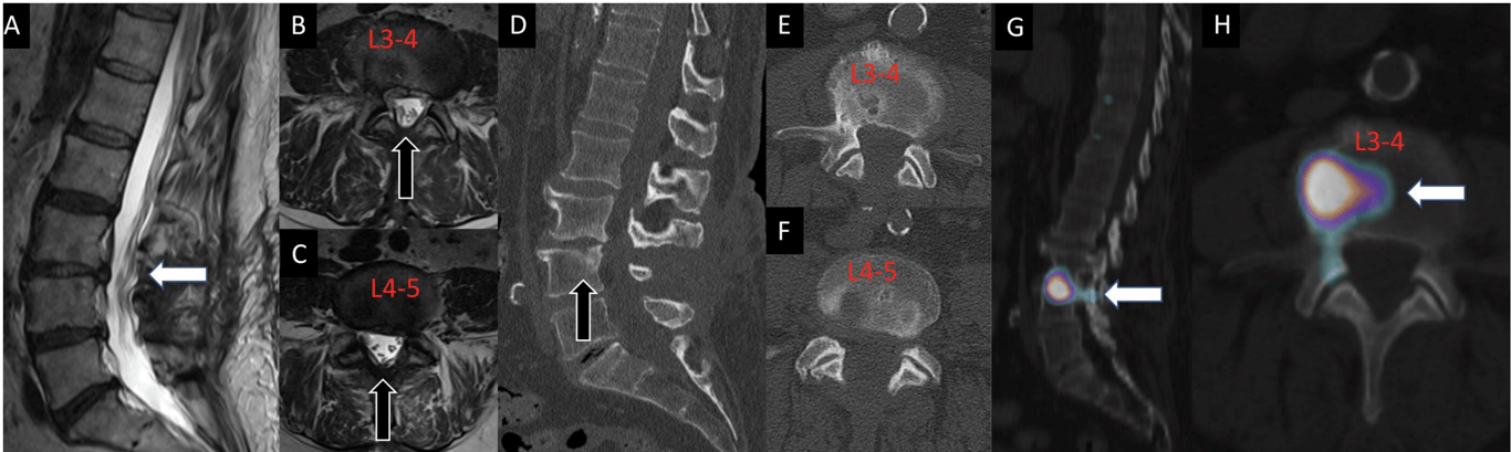 A 70-year-old man had previously undergone L3 to L5 decompression for lumbar spinal stenosis with leg dominant radicular pain. After the decompression, the patient presented with a new complaint of axial flexion-dominant mid-lumbar pain in the absence of leg symptoms. Advanced imaging demonstrated no significant residual/recurrent stenosis on sagittal and axial T2-weighted MRI sequences (A, B, C) and appropriate decompression on sagittal and axial computed tomography images without evidence of pars interarticularis fracture or subtotal facetectomy (D, E, and F). Single photon emission computed tomography with computed tomography findings demonstrated increased radiotracer uptake in the L3 to L4 disc (G and H). The L3 to L4 disc was determined to be the dominant pain generator, resulting in a discogenic pain pattern. The patient was then referred for further physical therapy and physical medicine and rehabilitation.