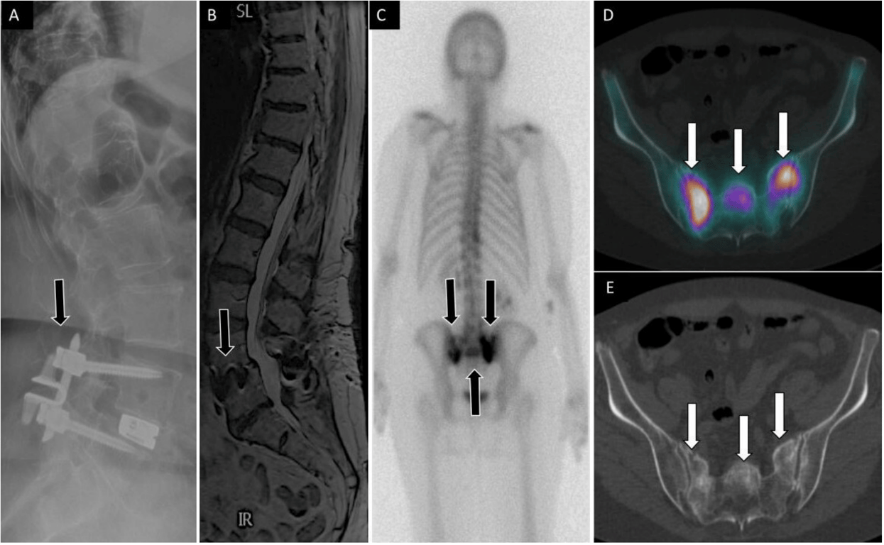 71-year-old woman with low back, buttock, and bilateral leg pain. Lateral (A) spine radiograph shows L4 to L5 instrumentation with prior interspinous spacer and unilateral pedicle screws with interbody device (arrow) without evidence of complications. Lumbar spine T2 sagittal magnetic resonance image (B) shows no central canal stenosis, also seen on axial (not displayed) and metal artifact at L4 to L5 (arrow) related to instrumentation. Posterior planar 99mTc-MDP bone scan (C) and axial fused single photon emission computed tomography with computed tomography (D) images show H-shaped radiotracer uptake within the sacrum, with associated sclerotic changes on computed tomography (E), compatible with sacral insufficiency fracture.
