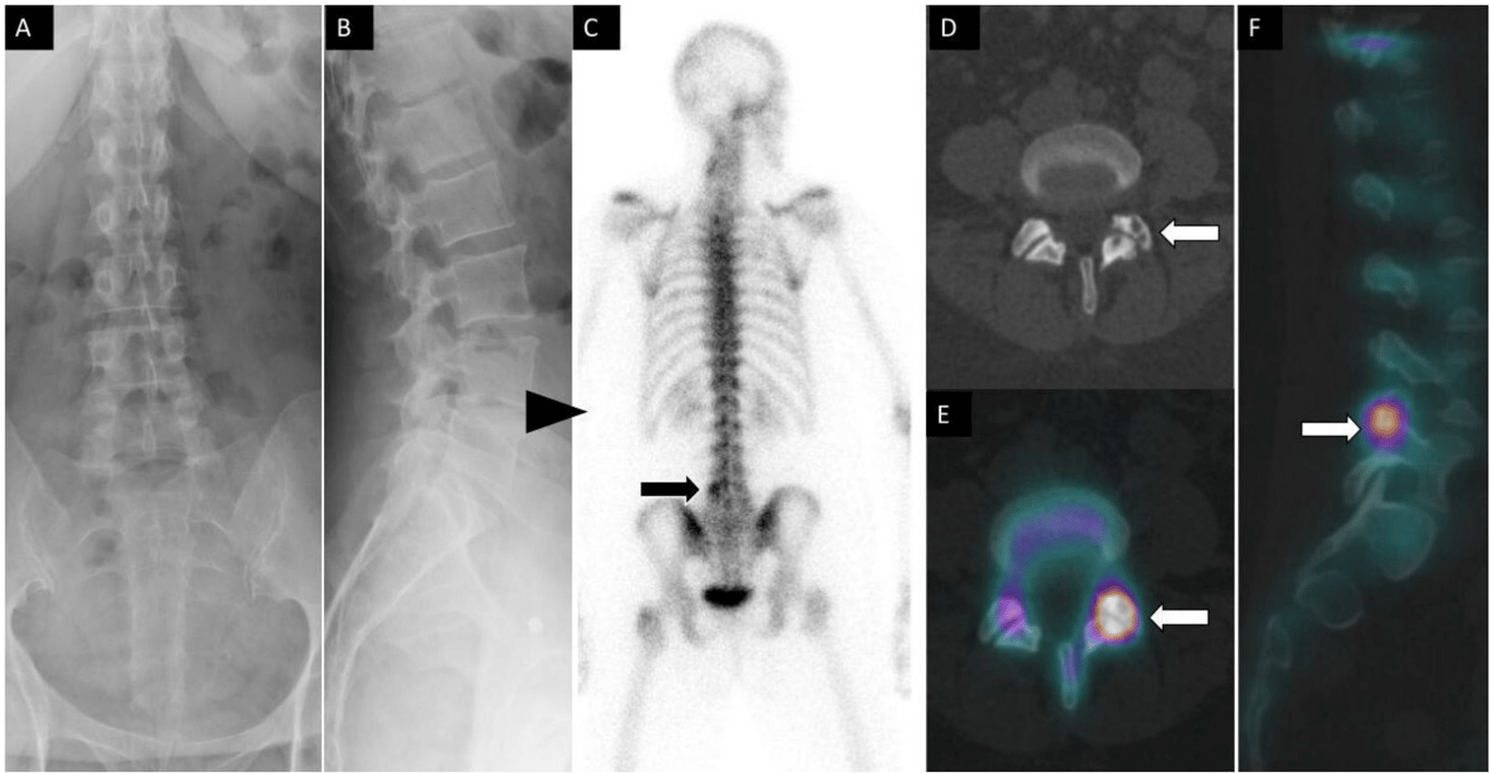 A 52-year-old woman had lumbar back pain. Anteroposterior (A) and lateral (B) spine radiographs show mild multilevel degenerative disc narrowing most notable at L4 to L5 (arrowhead). Posterior planar 99m-methyl diphosphonate bone scan image (C) shows focal increased osteoblastic activity within the left lateral aspect of L5 vertebra. Axial noncontrast computed tomography (CT) (D) and fused axial (E) and coronal (F) single photon emission CT with CT images demonstrate increased osteoblastic activity within the left L4 to L5 facet joint with associated subchondral cysts and joint space narrowing compatible with degenerative facet arthropathy