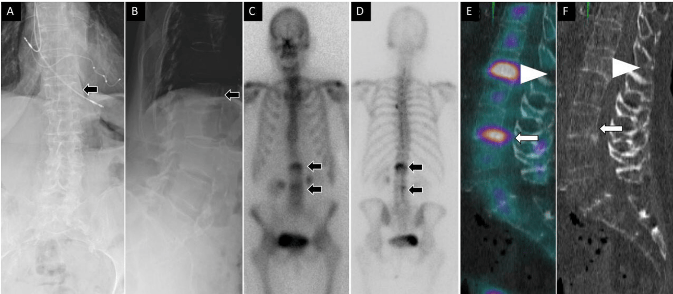 A 76-year-old woman presented with acute-onset low back pain. Anteroposterior (A) and lateral (B) spine radiographs show mild height loss at the level of the L1 vertebral body (arrow). Anterior (C) and posterior (D) planar 99mTc-MDP bone scan images show focal increased osteoblastic activity at L1 and L3 vertebral levels (arrows). Sagittal fused single photon emission computed tomography with computed tomography (E) demonstrates increased activity at the L1 and L3 vertebral bodies. Noncontrast computed tomography images (F) demonstrate corresponding height loss (arrowhead) at the L1 vertebral body and inferior endplate irregularity and linear sclerotic changes (arrow) at the L3 vertebral body, compatible with healing vertebral compression fractures.