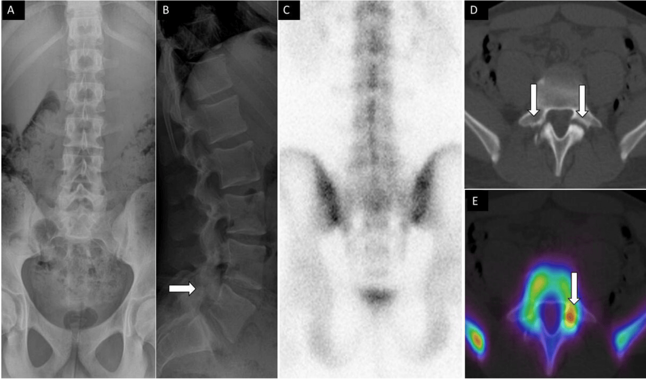 A 14-year-old male football player presenting with low back pain. Anteroposterior (A) and lateral (B) spine radiographs show subtle lucency on the lateral view within the L5 pars interarticularis (arrow). Posterior planar 99mTc-MDP bone scan image (C) was unremarkable. Axial noncontrast computed tomography (CT (D) and fused single photon emission CT with CT (E) images demonstrate bilateral pars defects, with asymmetric increased activity within the left pars defect,
respectively