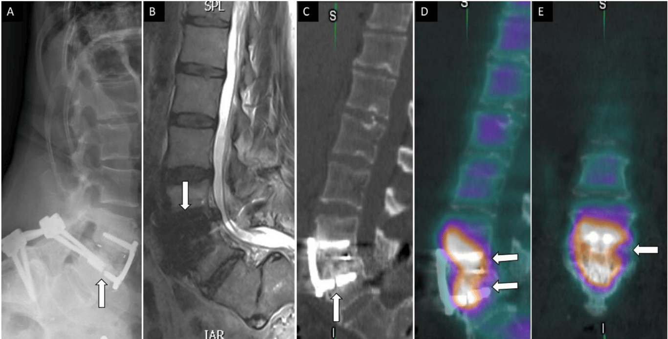A 56-year-old woman presented with low back pain after prior L4 to S1 posterior instrumented fusion and subsequent standalone L3 to L4 anterior lumbar interbody fusion with anterior plate fixation. Lateral lumbar spine radiograph (A) shows fractured screw related to anterior instrumentation at the level of L4 (arrow). Sagittal T2 magnetic resonance imaging (B) shows no evidence of acute central canal stenosis and metal artifact (arrow) related to instrumentation. Sagittal noncontrast computed tomography (C) demonstrates fractured screw into the L4 vertebral body and sclerotic changes within the bone. Fused sagittal and coronal images demonstrate increased osteoblastic activity and radiotracer uptake within the L3 to L4 disc space concerning for hardware loosening and pseudoarthrosis