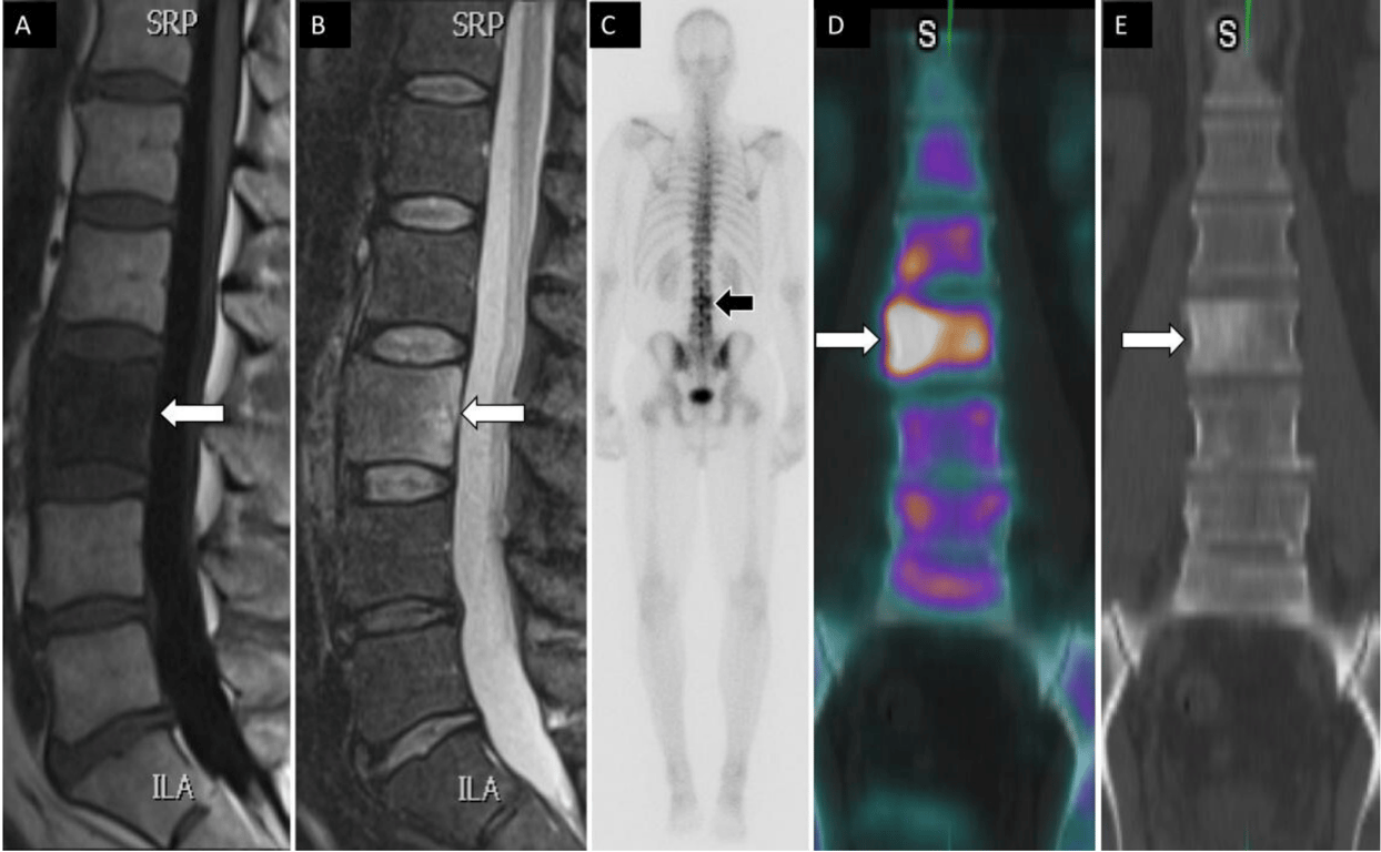 A 49-year-old man had a history of tonsillar squamous cell carcinoma and low back pain. Sagittal T1 (A) and STIR (B) magnetic resonance images show low T1 and high T2 signal changes within the L3 vertebral body (arrows). Posterior planar 99mTc-MDP bone scan image (C) shows increased osteoblastic activity at L3 vertebral body. Coronal fused single photon emission computed tomography with computed tomography image (D) demonstrates an osteoblastic lesion within the right L3 vertebral body with associated sclerotic changes on computed tomography (E) compatible with metastatic bone lesion.