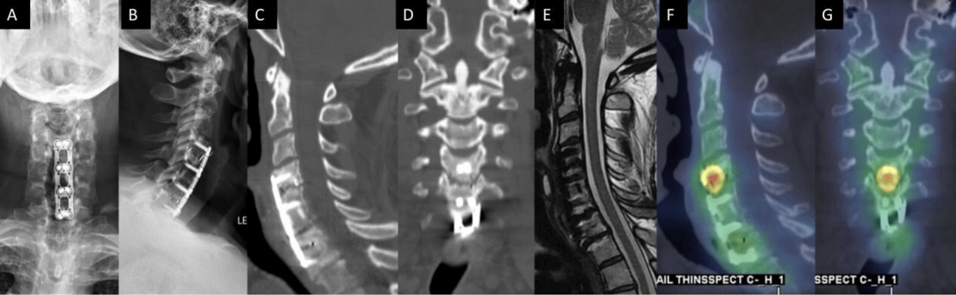 A 54-year-old man presented with persistent axial mechanical neck pain after previously undergoing C4-7 anterior cervical discectomy and fusion 2 years earlier. Anteroposterior (A) and lateral (B) plain films demonstrated all implants from the index surgery were appropriately positioned. Sagittal (C) and coronal computed tomography (CT) reconstructions did not demonstrate any bridging bone across the C4-5 disc space. No residual/recurrent central stenosis was seen on mid-sagittal T2-weighted magnetic resonance imaging (E). Sagittal (F) and coronal (G) single photon emission CT with CT images demonstrated increased radiotracer uptake at the C4-5 level, which suggested symptomatic pseudarthrosis. The patient subsequently underwent posterior cervical instrumented fusion with good result.