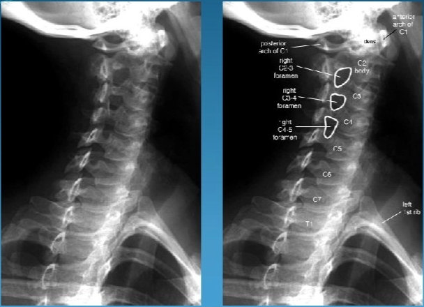 Introduction to Neuroimaging SPINE Ayegl Sarslmaz MD Radiology